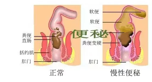 大便有血是怎么回事可能是痔疮肛裂炎症息肉或更严重疾病需就医