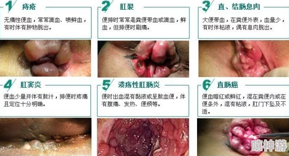 大便有血是怎么回事可能是痔疮肛裂炎症息肉或更严重疾病需就医